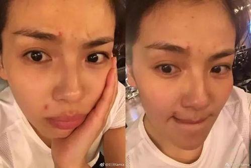 捏痘视频,揭秘捏痘视频背后的护肤真相